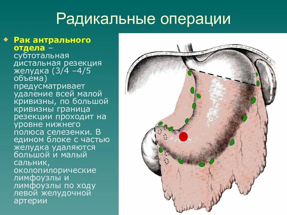 Язва операция сколько. Опухоль в антральном отделе желудка. Отделы желудка онкология. Радикальная субтотальная резекция желудка. Новообразование в желудке.