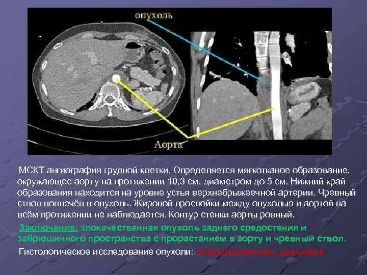 МСКТ ангиография аорты. Ангиография чревного ствола. На кт видно опухоль