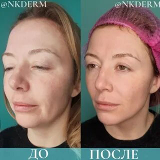 S лифтинг отзывы