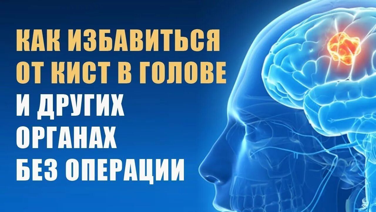 Киста в мозгах последствия. Препараты от кисты в голове. Лекарство от кисты головного мозга. Таблетки от кисты головного мозга. Таблетки от кисты в голове.