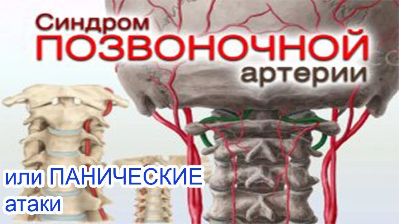 Мрт паническая атака. Вертебральный синдром позвоночной артерии. Ход позвоночной артерии. Синдром позвоночной артерии и панические атаки. Синдром позвоночной артерии симптомы.