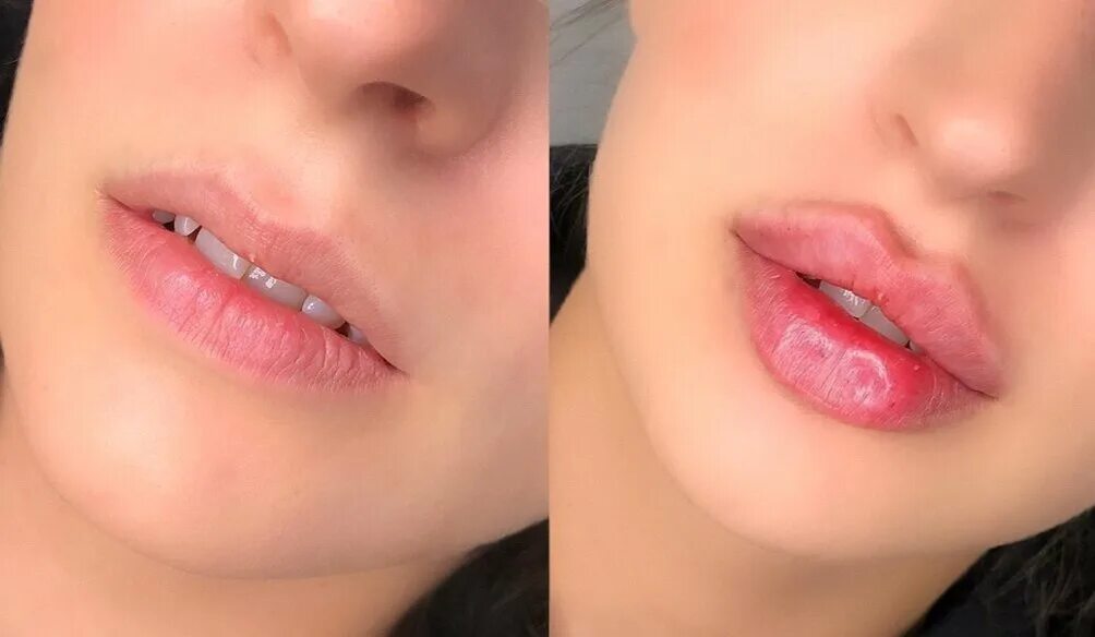 сколько стоят губы в москве. сколько стоят губы в москве. сколько стоят губы в москве. контурирование губ гиалуроновой кислотой. сколько стоят губы в москве.