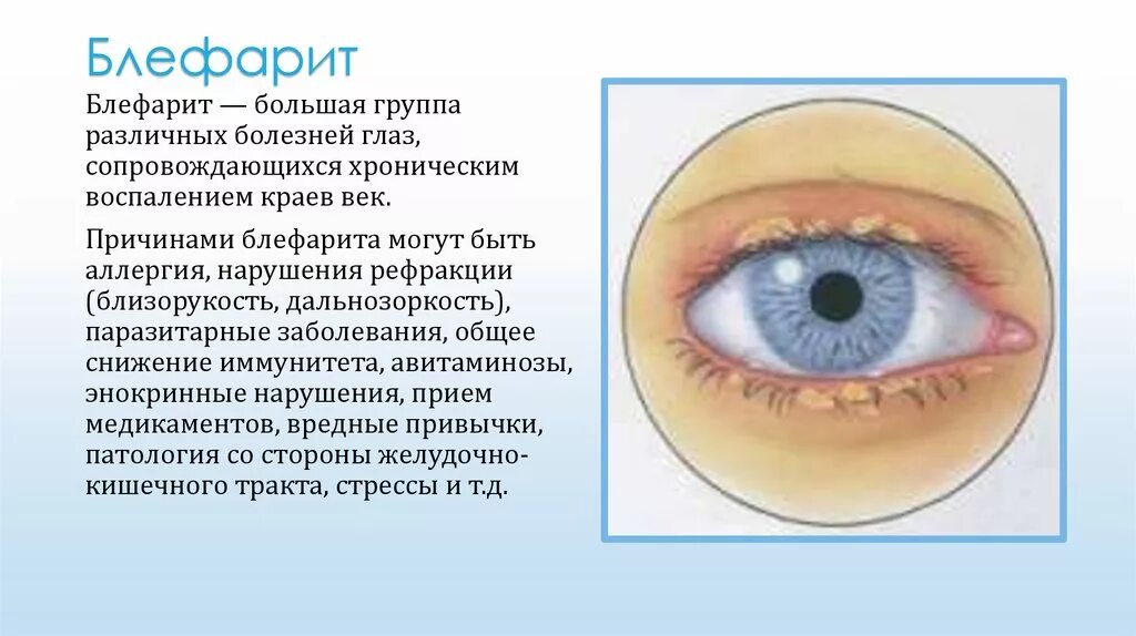 Хронические заболевания зрения. Блефарит конъюнктивит. Заболевание глаз блефарит. Глазная болезнь блефарит. Блефарит конъюнктивит ячмень.