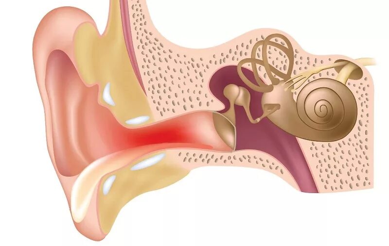 Что делать если сильно болит ухо внутри. Острый наружный отит диффузорный. Барабанная перепонка отит. Наружный отит барабанная перепонка.