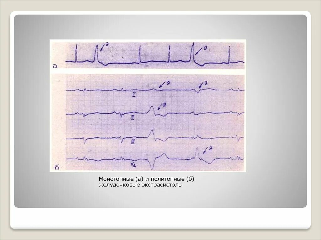 Политопные экстрасистолы. Монотопные экстрасистолы. Политопные желудочковые экстрасистолы на экг. Монотопная желудочковая экстрасистолия на экг. Желудочковая экстрасистолия на экг.