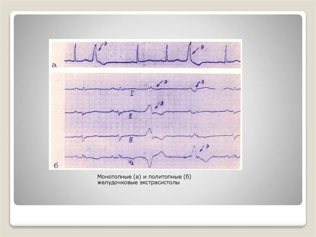 Политопная экстрасистолия на ЭКГ. Монотопные экстрасистолы. Полиморфные и политопные желудочковые экстрасистолы. Политопная желудочковая экстрасистолия на ЭКГ. Политопные экстрасистолы