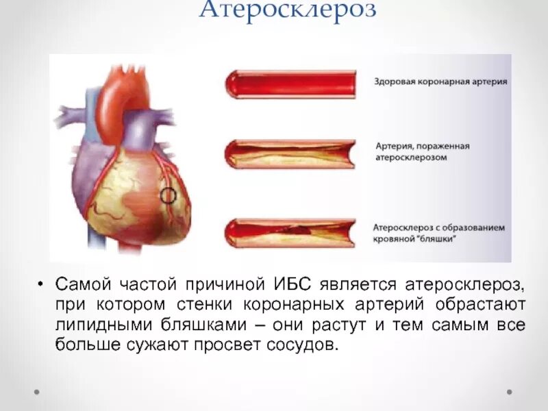 Отличие ишемии. Атеросклероз коронарных артерий симптомы. Симптомы атеросклероза коронарных артерий сердца. Атеросклероз венечных сосудов сердца симптомы. Атеросклероз коронарных сосудов симптомы.