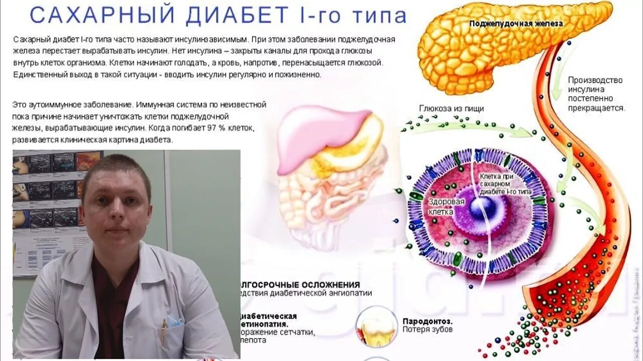 Сахарный диабет поджелудочная железа с бета клетками. Сахарный диабет 1 типа поджелудочная железа. Сахарный диабет 2 поджелудочная. Панкреатогенный сахарный диабет. Диабет пересадка поджелудочной железы