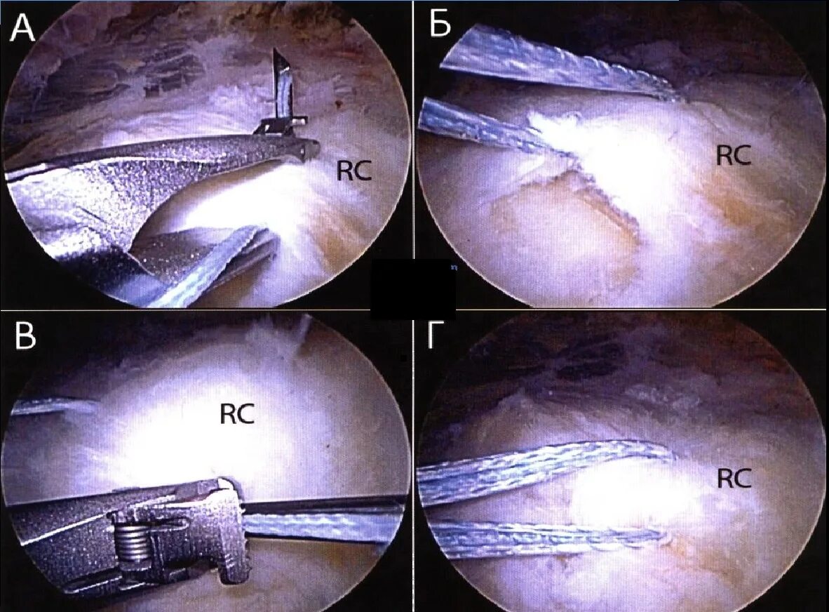 Плечевая губа суставная разрыв. Повреждения плеча вращательной манжеты s46. Ротаторная манжета шов. Разрыв суставной губы плечевого. Операция суставной губы.