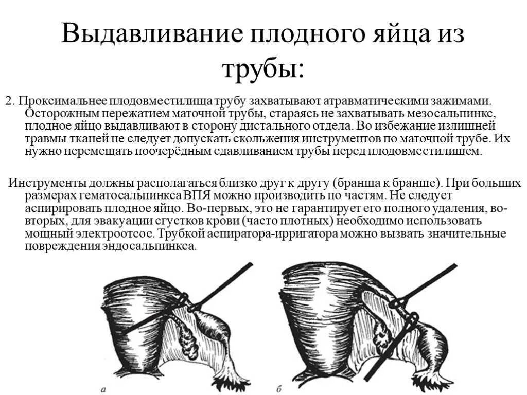 Маточные трубы удаление месячные. Выдавливание плодного яйца из маточной трубы. Операция резекция внематочной беременности. Операции при трубной беременности. Этапы операции при внематочной беременности.