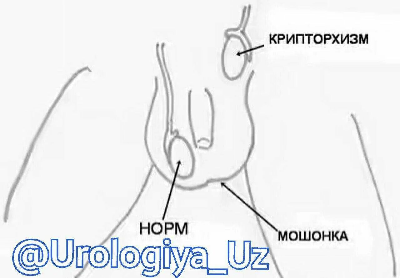 Неопущение яичек (крипторхизм). Не опускаются яички что делать