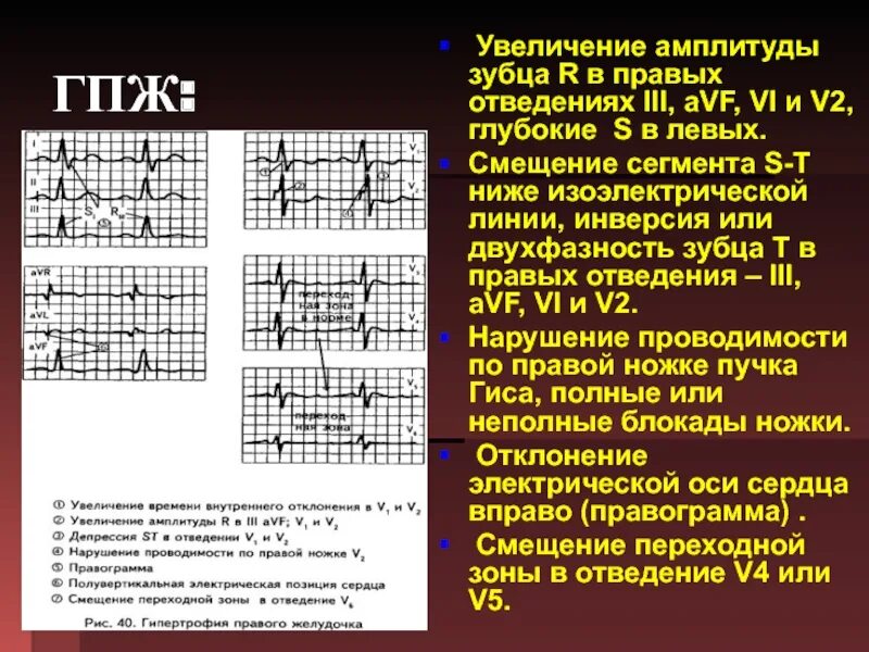 Валентная зона. Переходная зона на экг смещение. Переходная зона. Переходная зона пугмк баум. Визуализация переходной зоны внк.