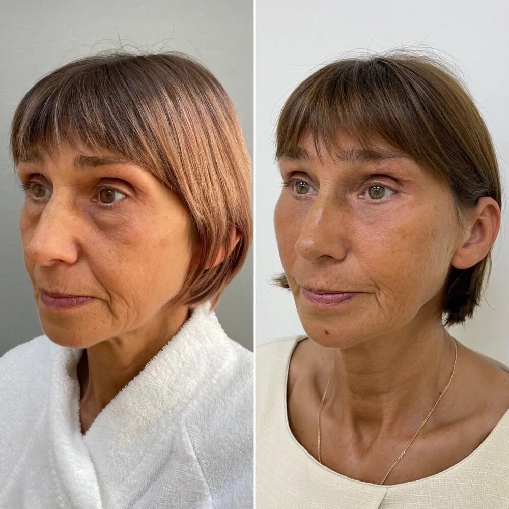 Пластика лица. Омолаживающие операции лица. Круговая подтяжка лица до и после. Фейслифтинг для лица. Фейслифтинг для лица.