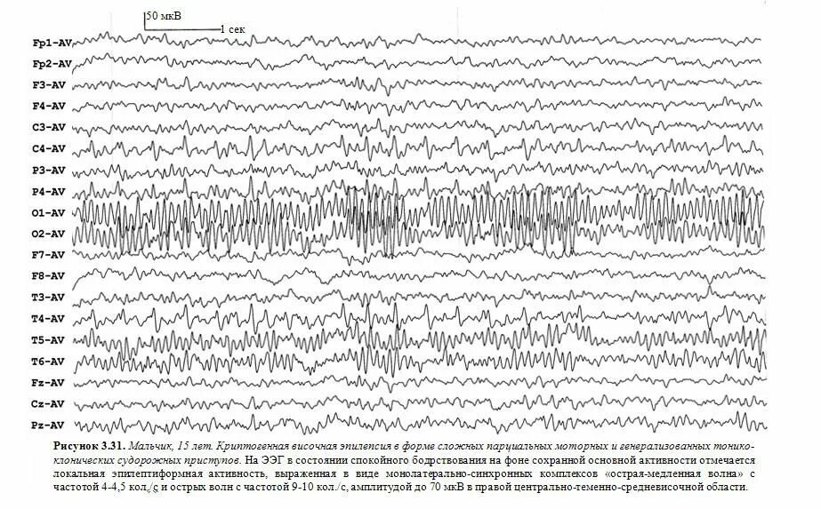 Эпилептиформная активность на ЭЭГ. Гипсаритмия на ЭЭГ. Паттерн ЭЭГ. Височная эпилепсия на ЭЭГ.