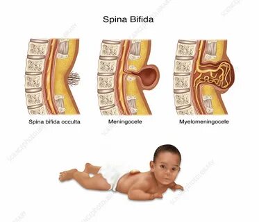 Spina bifida это