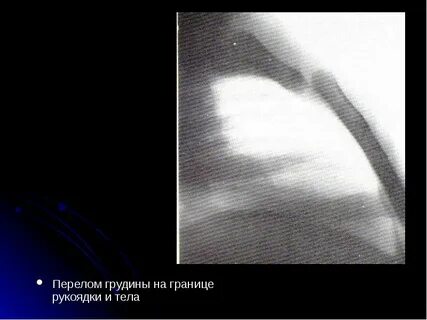 Перелом грудины без смещения