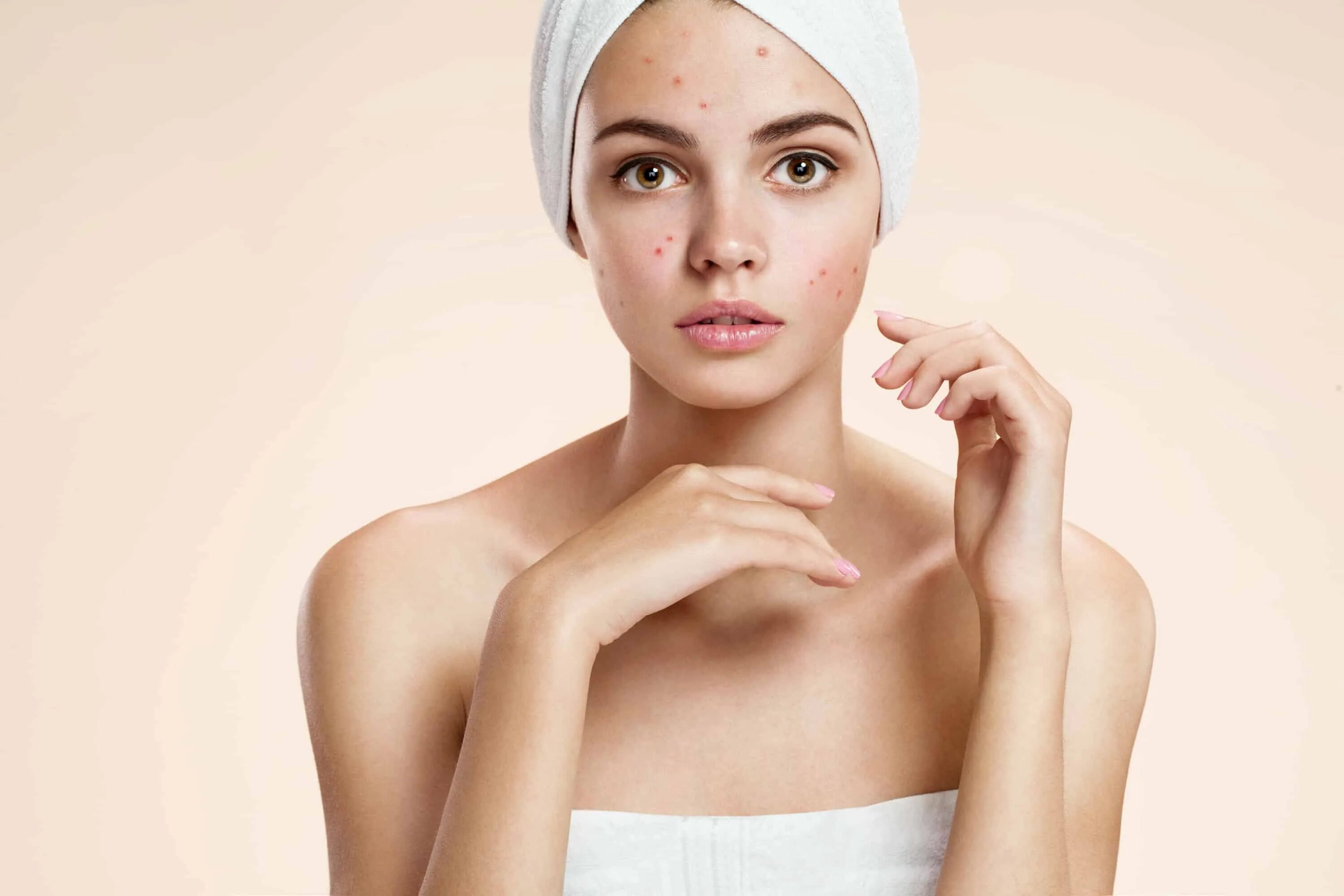 Типы кожи лица в косметологии. Девушка с проблемной кожей. Cares acne skin care. Skin care girl. Cares acne skin care.
