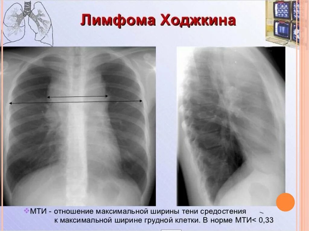 Легкие увеличен узел. Лимфома Ходжкина рентген. Лимфогранулематоз средостения рентген. Лимфогранулематоз лёгких на рентгене. Диагностические клетки лимфомы Ходжкина.