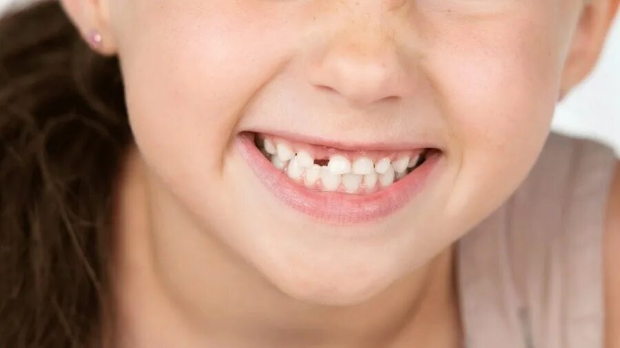 4 года зубы выпадают. Молочные зубы у детей. Вырадкник зубов у ребенка.