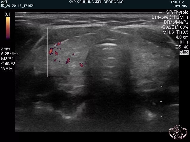 АИТ на УЗИ щитовидной железы. Протокол УЗИ щитовидной железы аутоиммунный тиреоидит. Тиреоидит щитовидной железы на УЗИ.