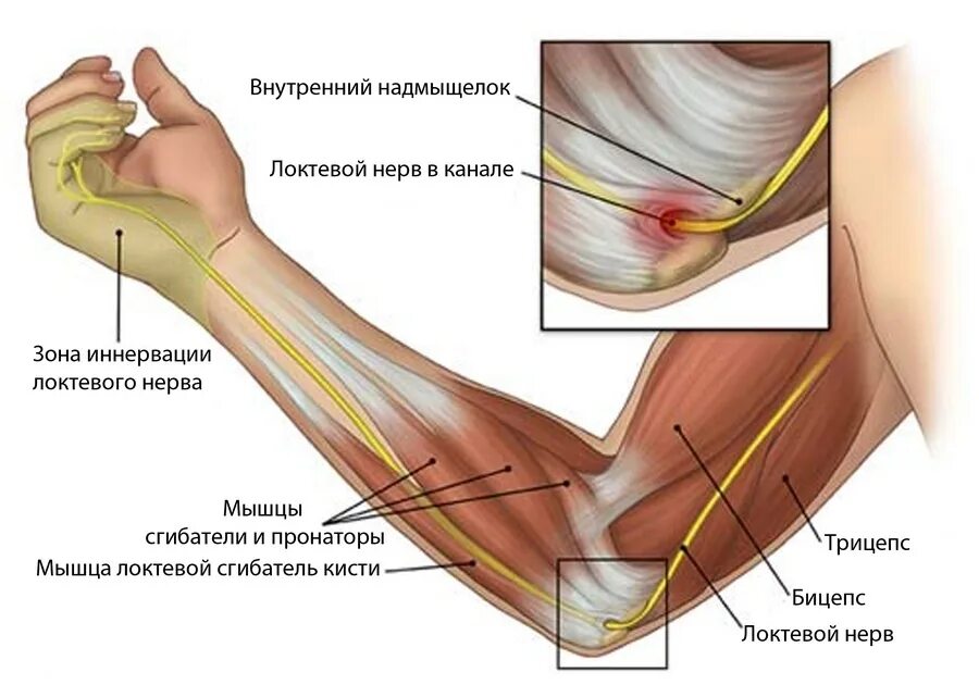 Боли в сухожилиях и мышцах