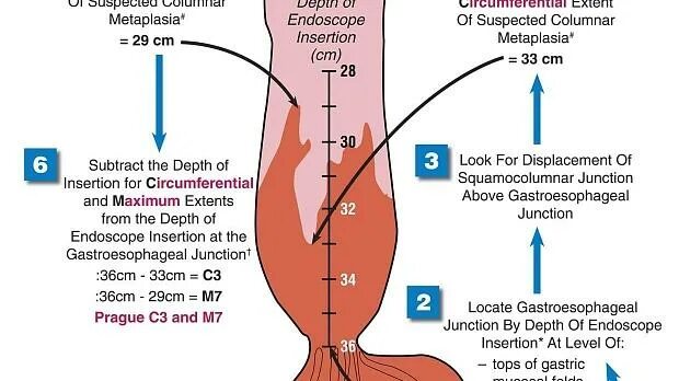 Жгучие боли в пищеводе. Пражская классификация пищевода Барретта. Пражская классификация пищевода Барретта с м. Пражские критерии пищевода Барретта. Пражская классификация пищевода Барретта с м критерии.