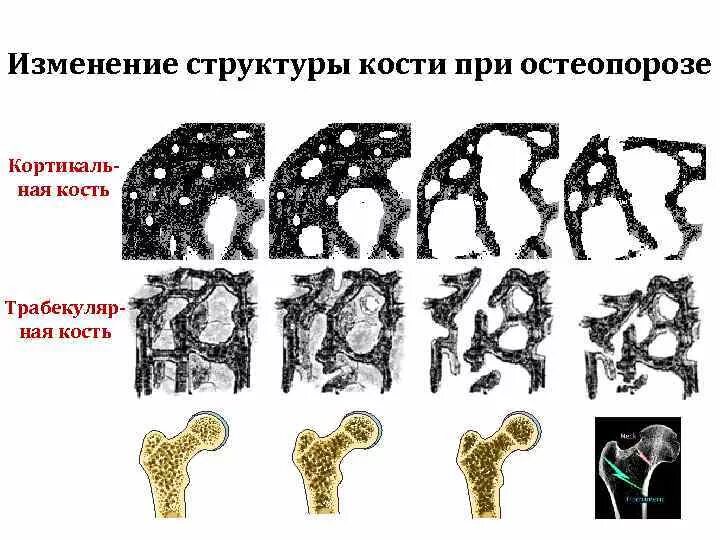 Изменение структуры кости. Структурные изменения кости. Разряжение костной структуры. Трабекулярная кость и кортикальная кость.