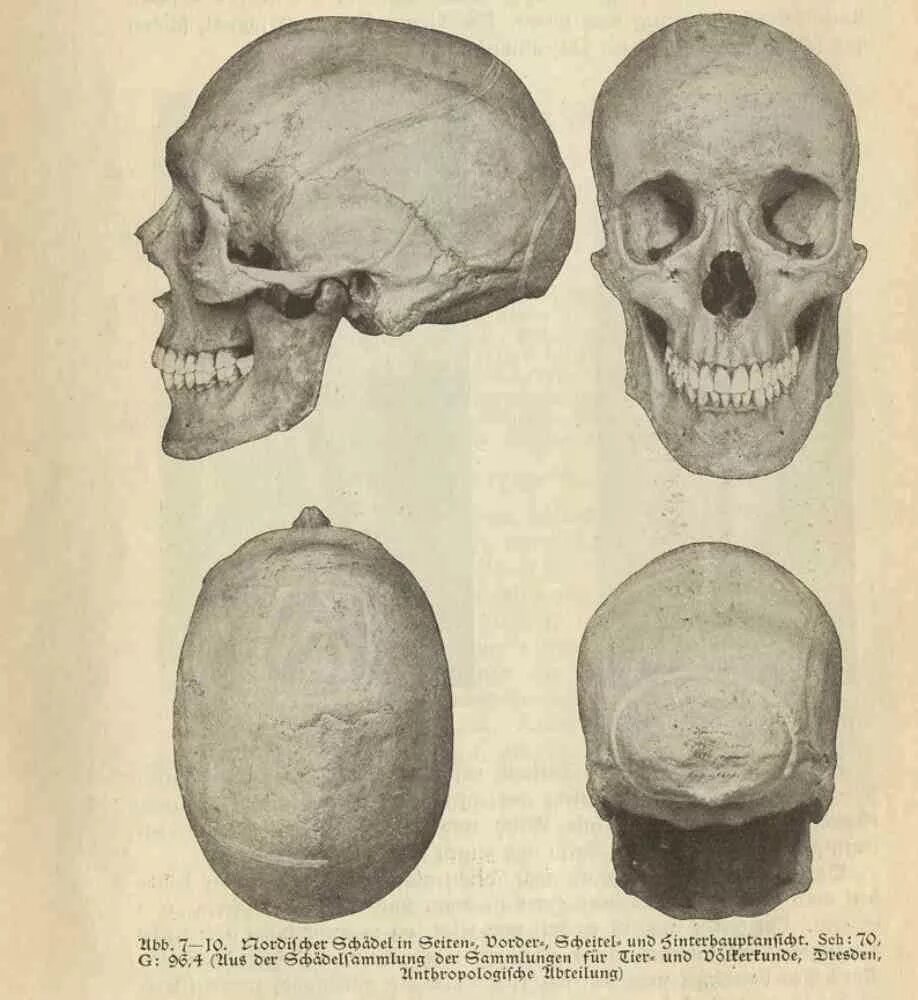 Варианты формы черепа. Деформация черепа долихоцефалия. Форма человеческого черепа. Формы человеческих черепов.