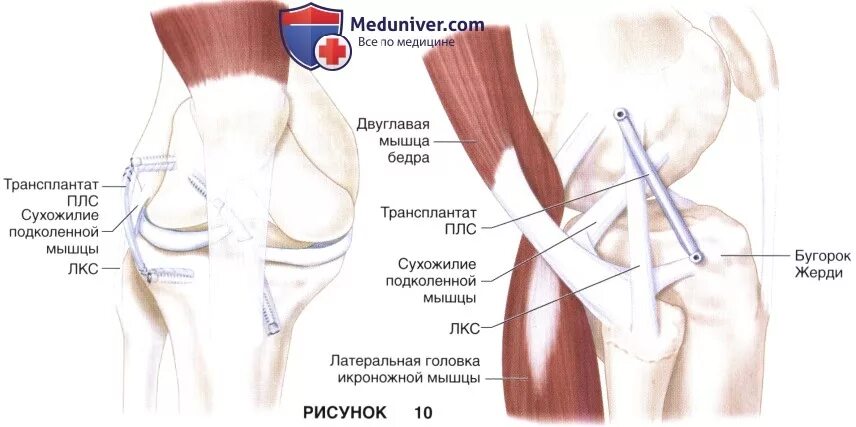 Чебоксары суставы операция. Реконструкция передней крестообразной связки коленного сустава. Сшивание связок коленного сустава. Реконструкция крестообразной связки коленного сустава. Реконструкция ПКС коленного сустава.