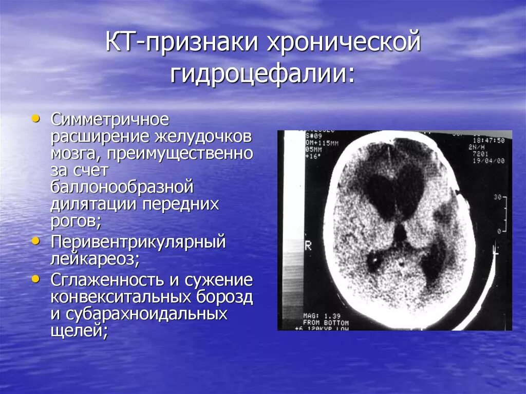 Дилатация бокового желудочка мозга. Наружная гидроцефалия головного мозга кт. Гидроцефалия головного мозга на кт. Кт признаки гидроцефалии. Кт признаки внутренней гидроцефалии.