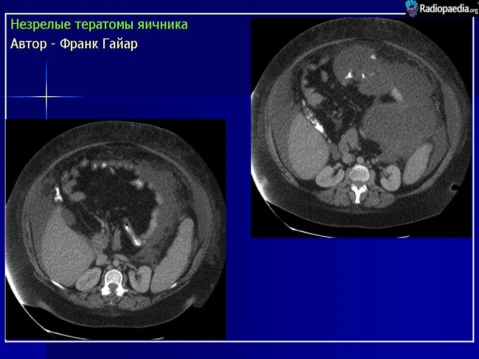 Рак яичника мрт. Незрелая тератома яичника.