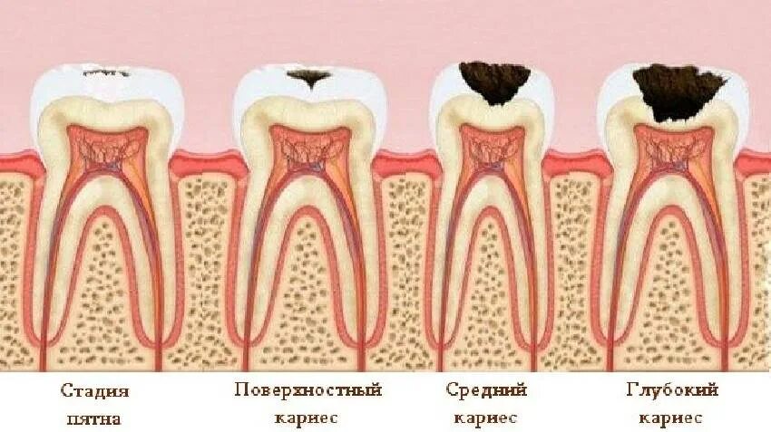 Кариес передается от человека к человеку. Кариес передается от человека к человеку