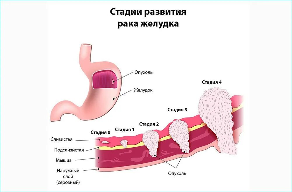 Как развивается рак желудка. Опухоль желудка стадии. биопсия слизистой желудка. степени онкологии желудка. стадии карциномы желудка.
