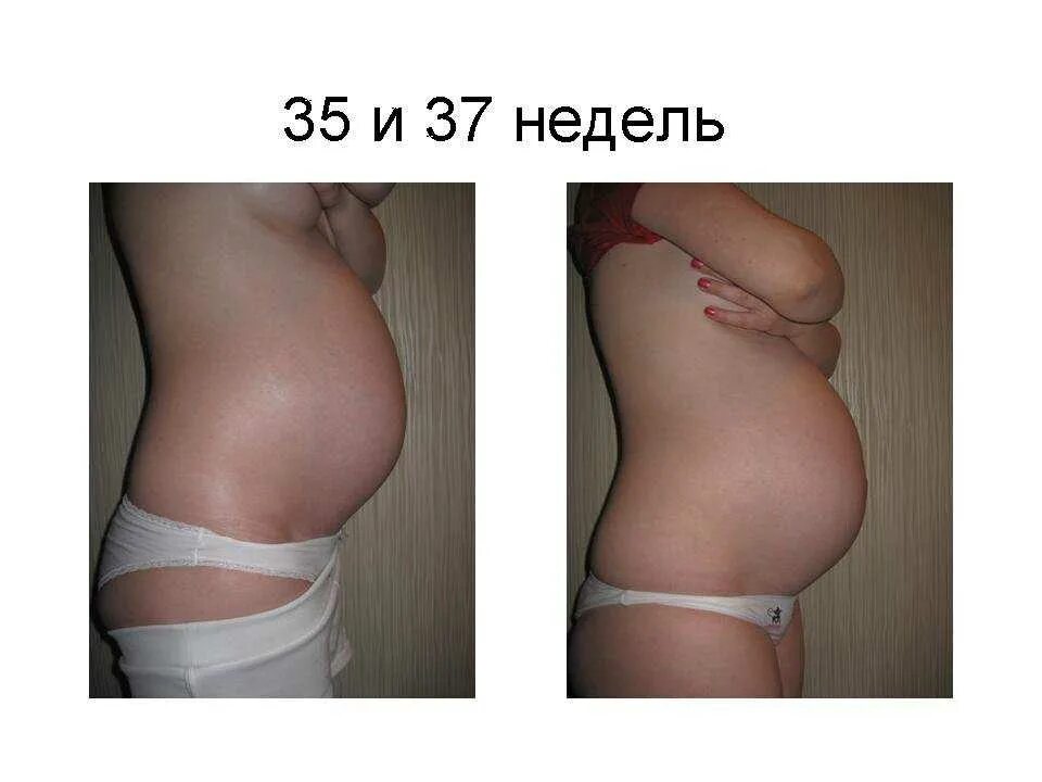 Опущение живота перед родами. Опущенный живот при беременности. Опущение живота у беременных. Опущенный живот перед родами. Опущение живота при беременности.