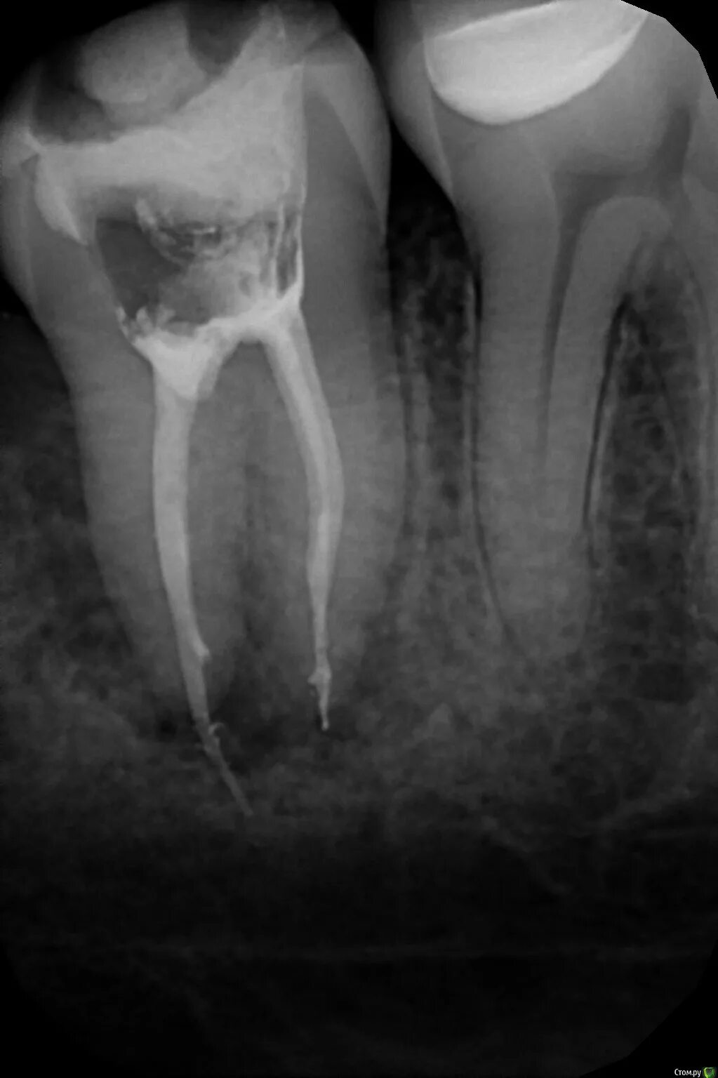 Пломбировка каналов зуба рентген. Пломбирование каналов рентген зуба.