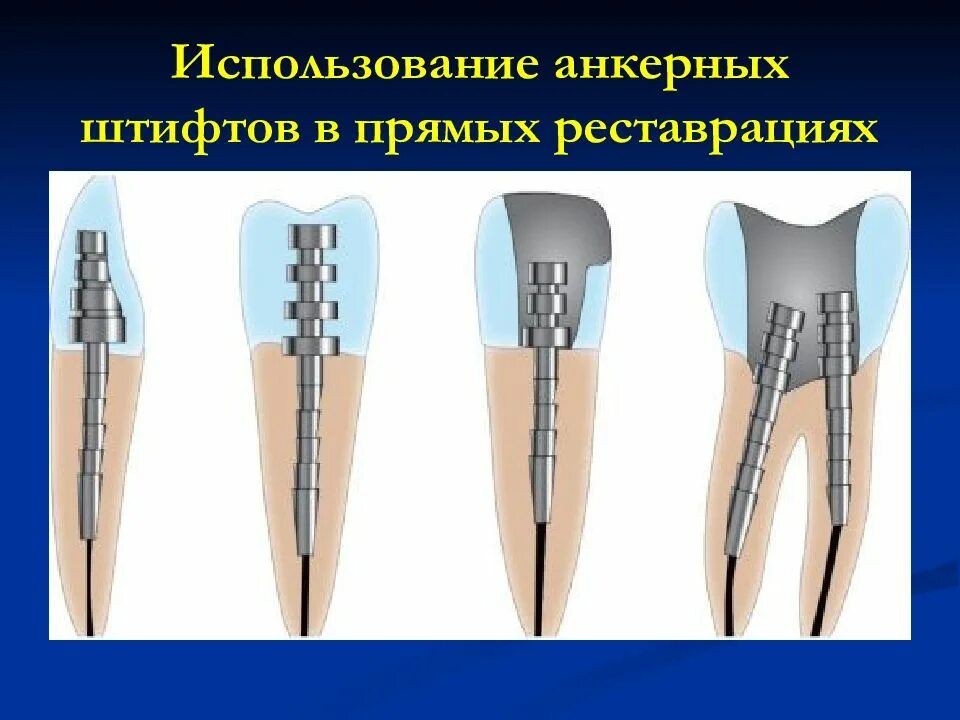 Анкер зубы. Анкерный и стекловолоконный штифт. стекловолоконный, анкерный штифт (фиксация, культя). анкерный штифт под коронку.