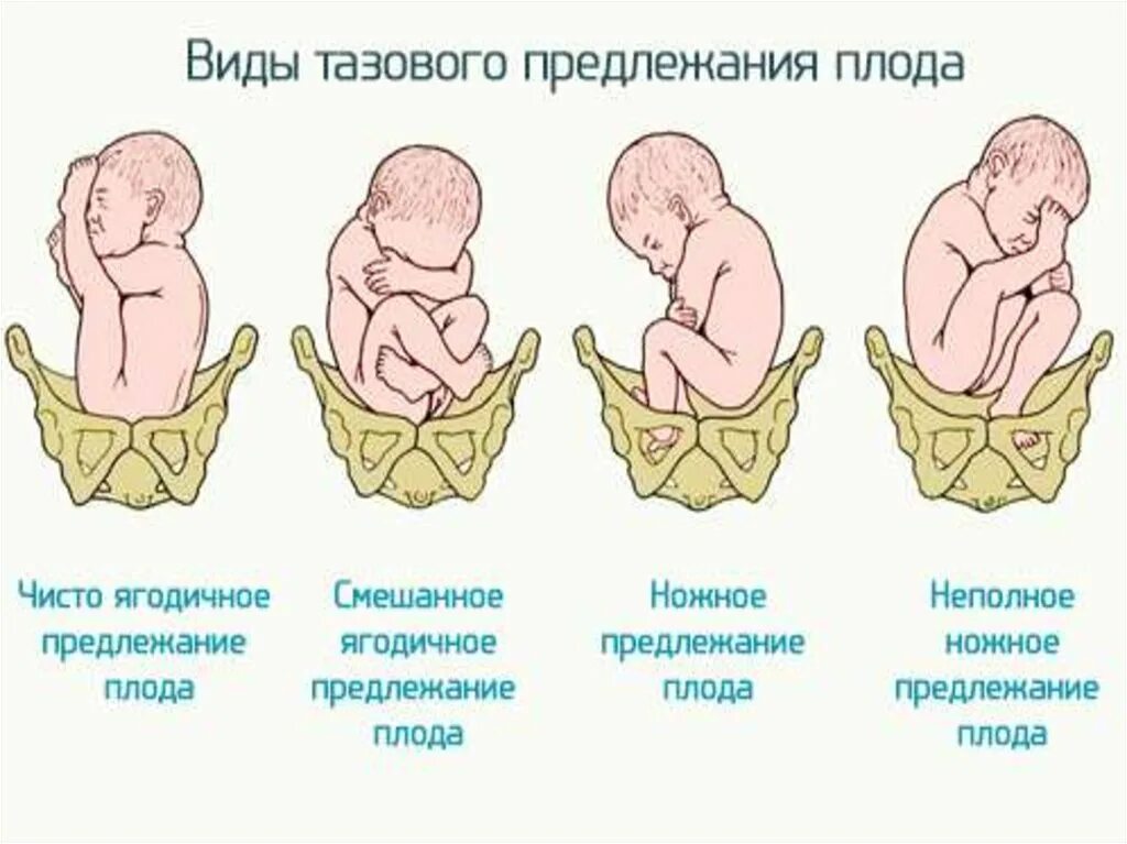 Продольное предлежание плода головное вниз. Тазовое предлежание плода классификация. Продольное положение плода тазовое предлежание плода. Признаки тазового предлежания плода. Новорожденный неделя после родов