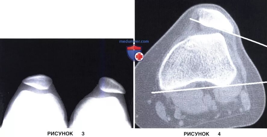Латерализация надколенника. Медиальный вывих надколенника. Надколенник Виберг 2. Вывих надколенника рентген. Перелом надколенника кт.