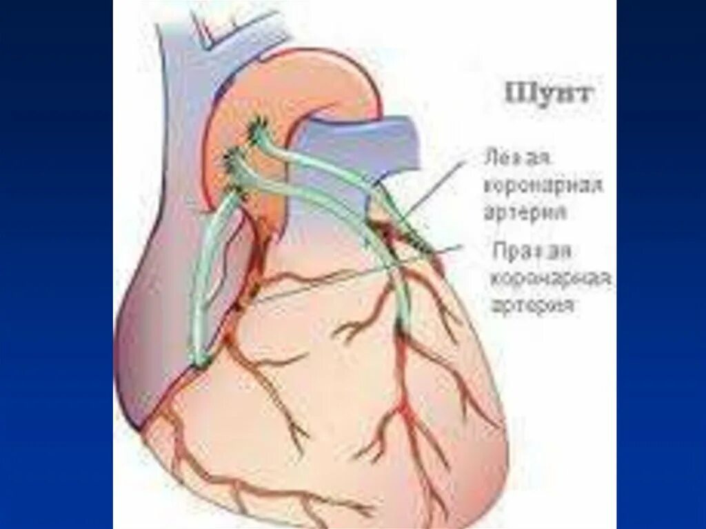 Включи шунт. Операция шунтирование сосудов сердца. Аортокоронарное шунтирование (АКШ). Аорта коронарное шунтирование. Маммарно коронарное шунтирование.