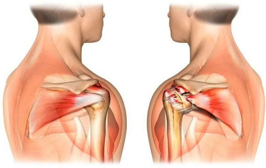 Ноющая боль в плече. Тендинит сухожилий ротаторной манжеты. Ротаторная манжета плеча анатомия. Тендинит надостной мышцы плечевого сустава. Повреждение ротаторной манжеты.