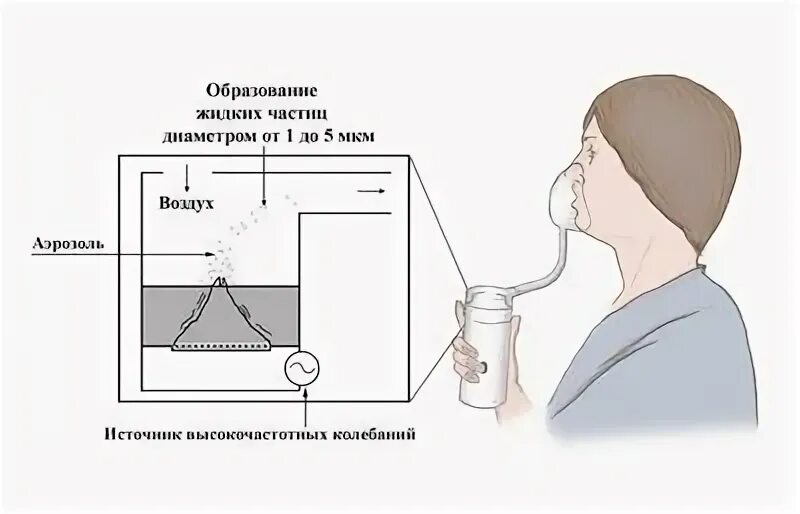 Правильная ингаляция при бронхите