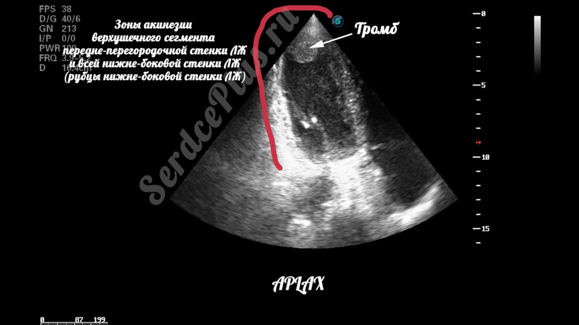 Тромб в желудочке. Сегменты левого желудочка на УЗИ сердца. Нижне-боковая стенка УЗИ сердца сегменты. Включения левого желудочка на УЗИ.