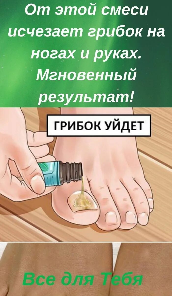 Как быстро избавиться от грибка на ногах. Избавление от грибка ногтей. избавление от грибка на ногах. избавиться от грибка ногтей в домашних условиях. как избавиться от грибка на ногтях.