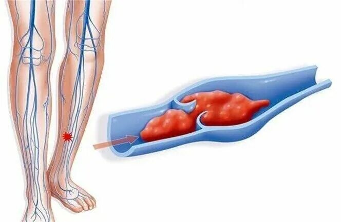 Флебит – воспаление вены. Тромбоз подколенной вены. Тромб в сосудах нижних