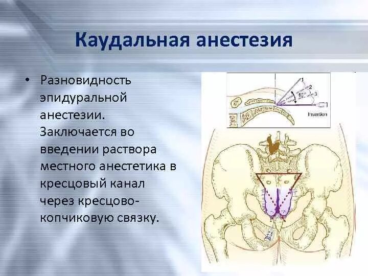 Каудальная (Сакральная) эпидуральная блокада. Каудальная блокада техника выполнения. Эпидуральная и каудальная анестезия. Каудальное направление