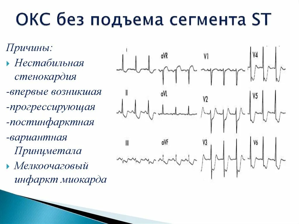 Острый коронарный синдром инфаркт. ЭКГ инфаркт миокарда без подъема St. Окс без подъема St на ЭКГ. Острый коронарный синдром без подъема сегмента St. ЭКГ Окс без подъема сегмента St.