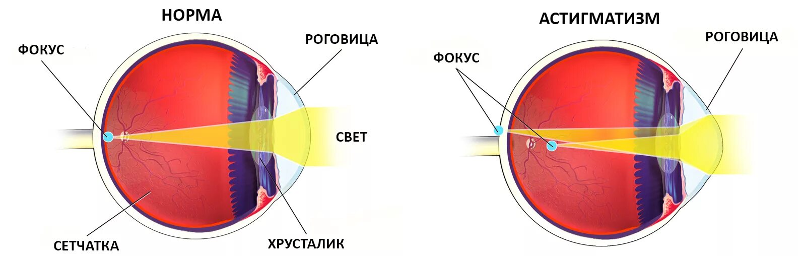 Глаз при астигматизме схема. Астигматизм роговицы глаза. Строение глаза астигматизм. Астигматизм 2.0. К оптической системе глаза относятся роговица хрусталик