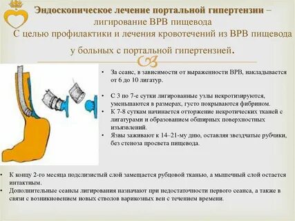 Способы остановки кровотечения из вен пищевода