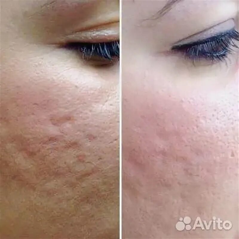 dermapen microneedling price Online Shopping