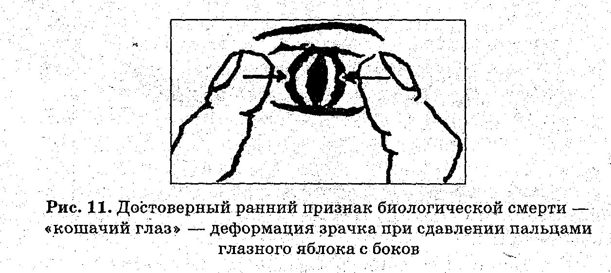 Признаки глазков. Кошачий глаз признак биологической смерти. Биологическая смерть симптомы кошачий глаз. Кошачий глаз при биологической смерти. Симптом Белоглазова кошачий глаз.